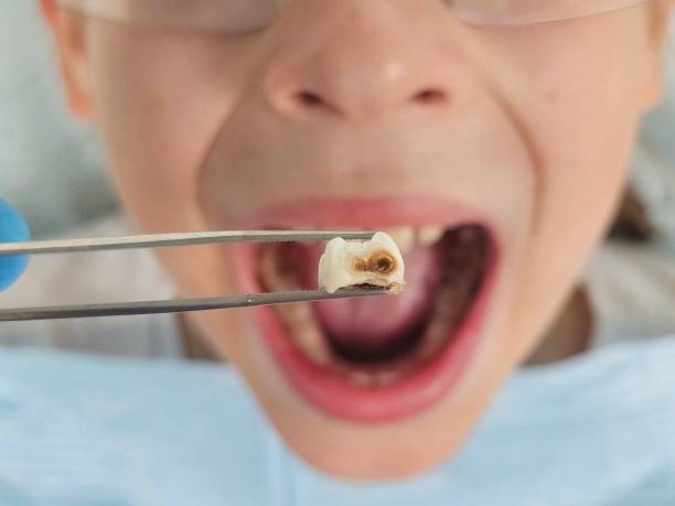 Best Urgent Care for Lost Fillings or Crowns in White Oak, MS