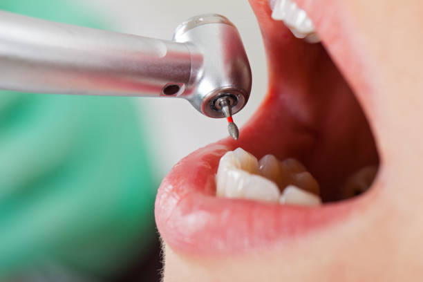 Best Emergency Dental Care for Broken or Chipped Teeth in White Oak, MS